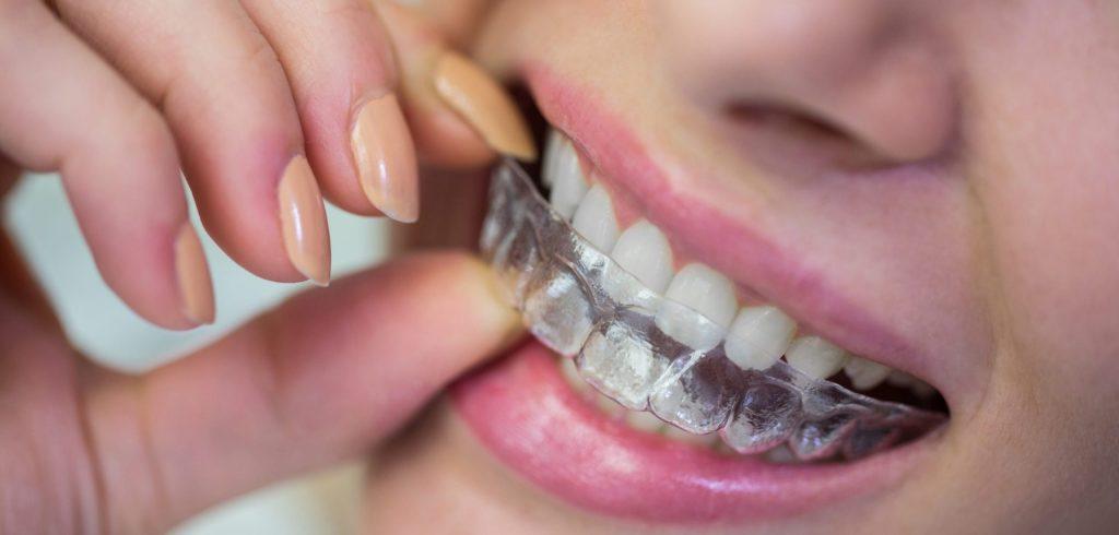 Close-up of woman wearing orthodontic silicone invisible braces