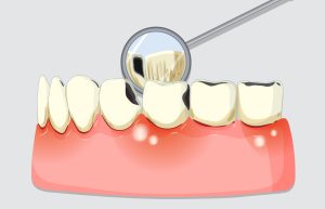 Dental Checkup with Mirror Tool
