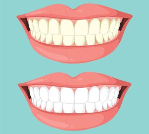 Before and After Teeth Whitening