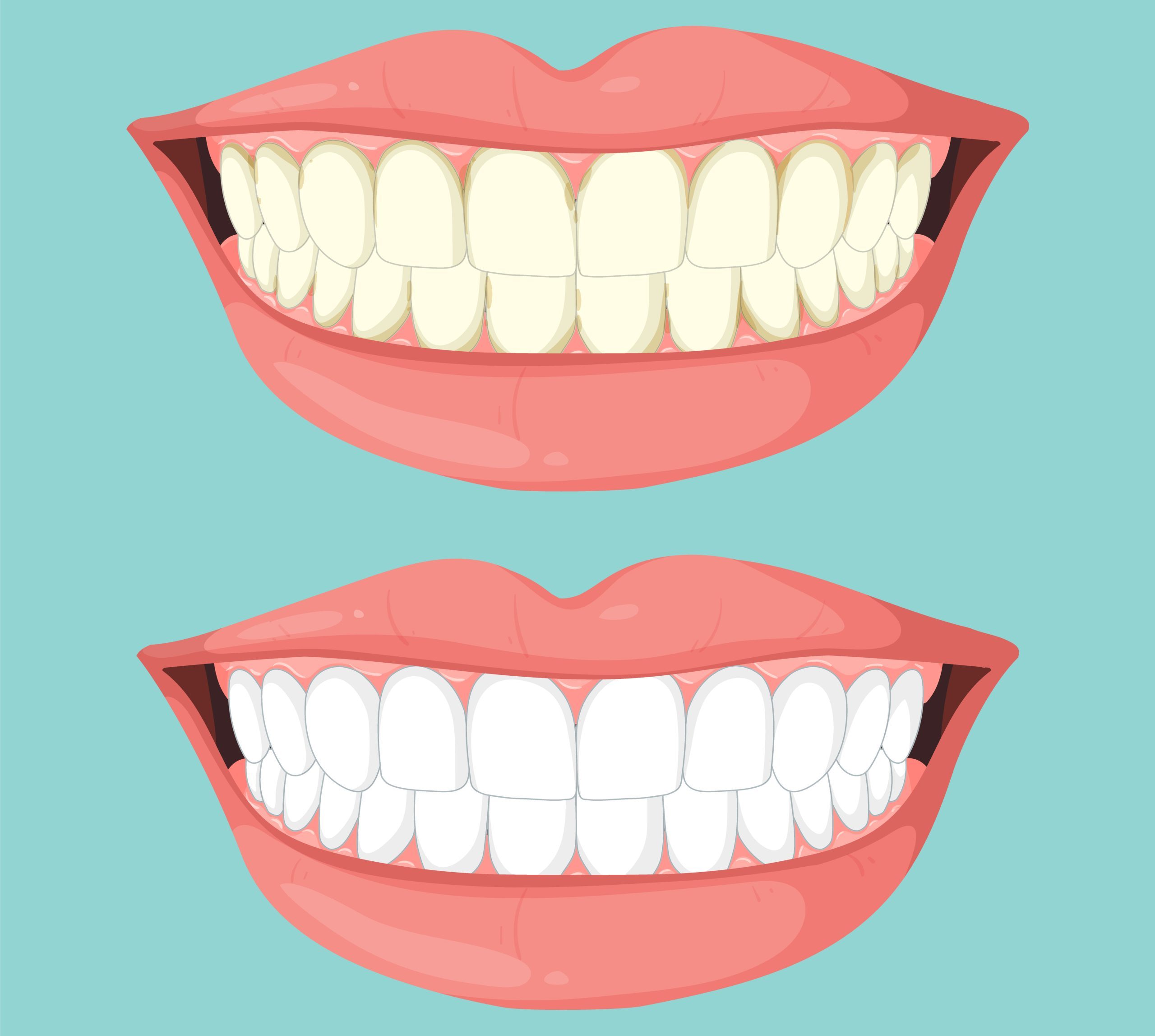 Before and After Teeth Whitening
