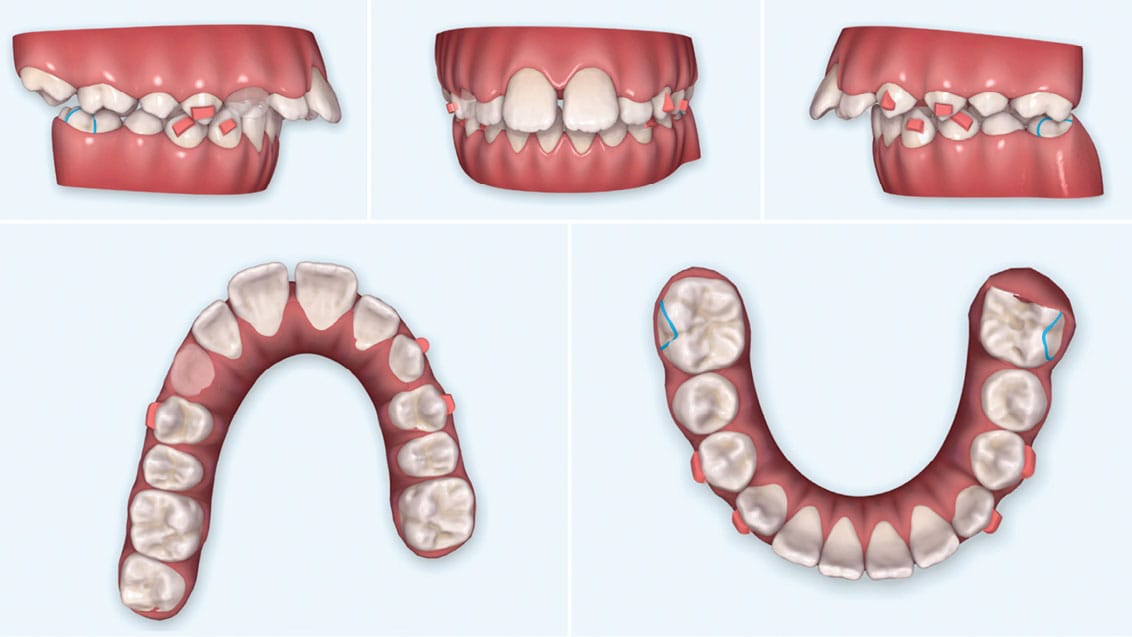 Invisalign in Champaign: Complete Clear Aligners Guide